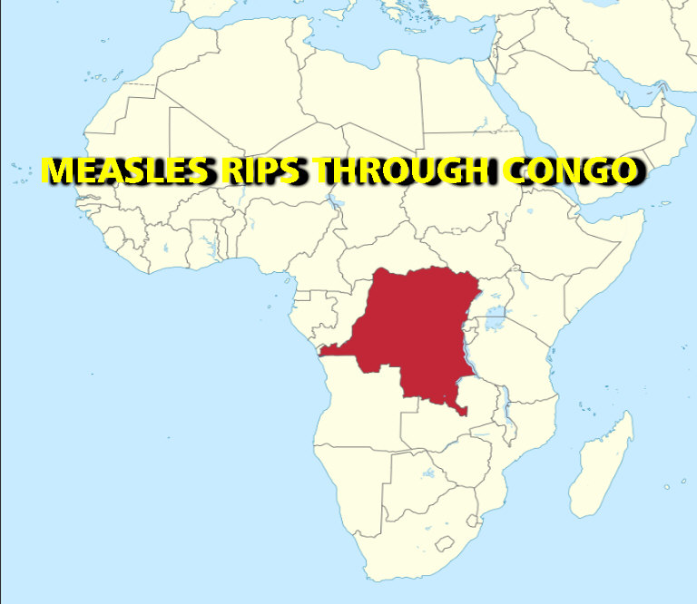 You are currently viewing MEASLES RIPS THROUGH CONGO