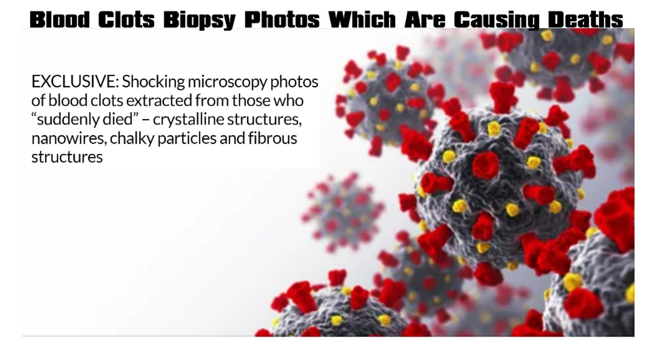 You are currently viewing Blood Clots Biopsy Photos Which Are Causing Deaths